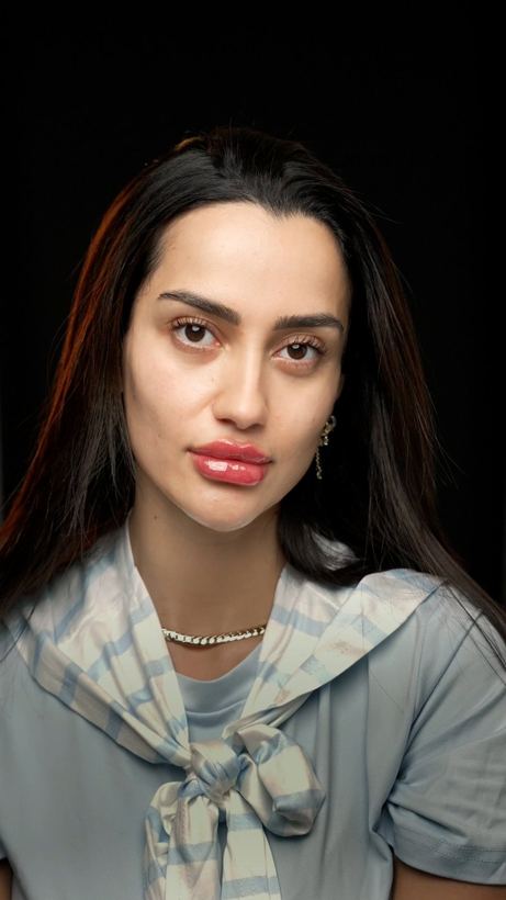 Lip filler patient after